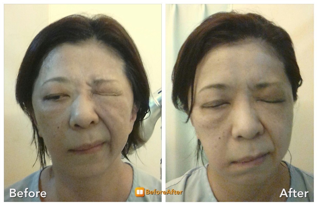 顔面神経麻痺 鍼灸治療レポート7 Hari Up ハリアップ Dr Liu Method 顔面神経麻痺 鍼灸治療レポート7 Hari Up ハリアップ Dr Liu Method
