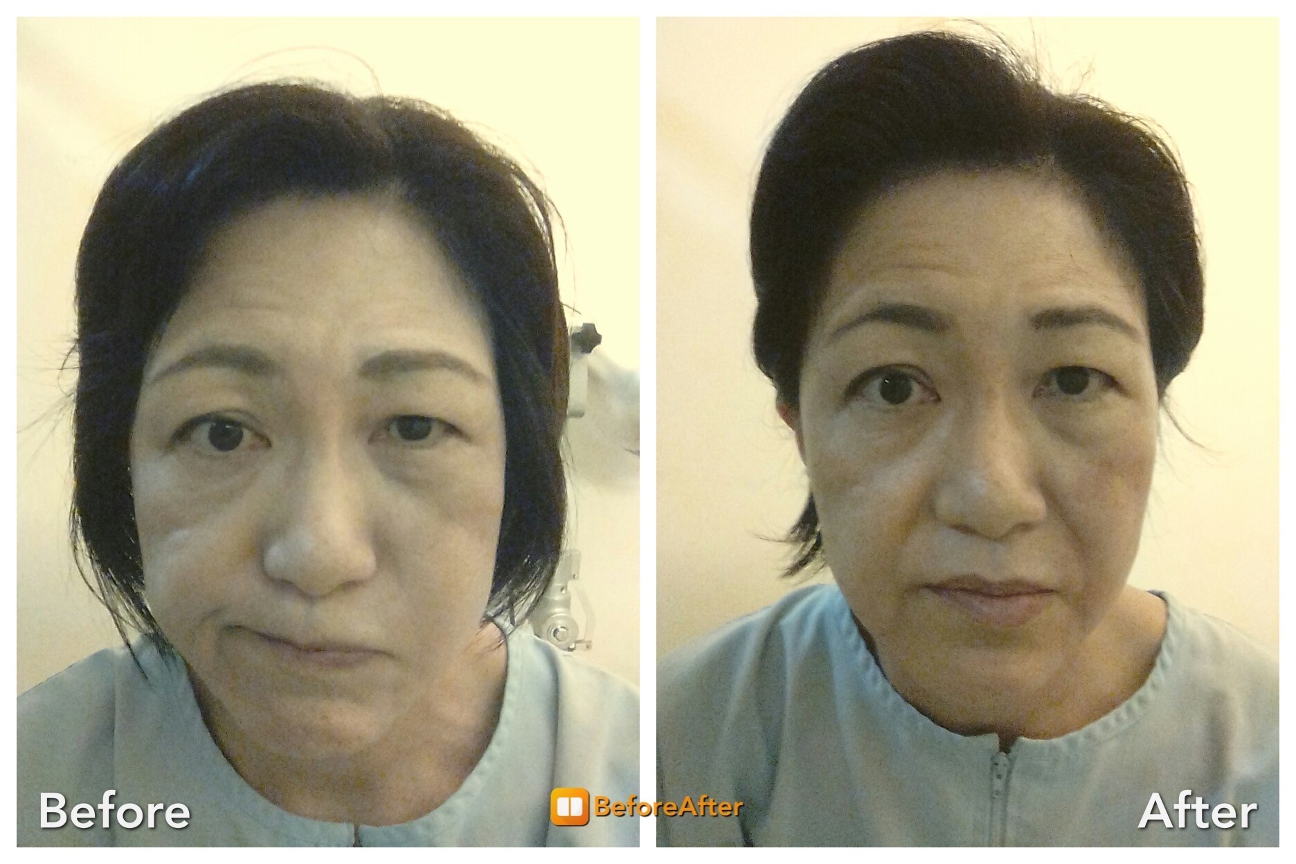 顔面神経麻痺 鍼灸治療レポート6 Hari Up ハリアップ Dr Liu Method 顔面神経麻痺 鍼灸治療レポート6 Hari Up ハリアップ Dr Liu Method