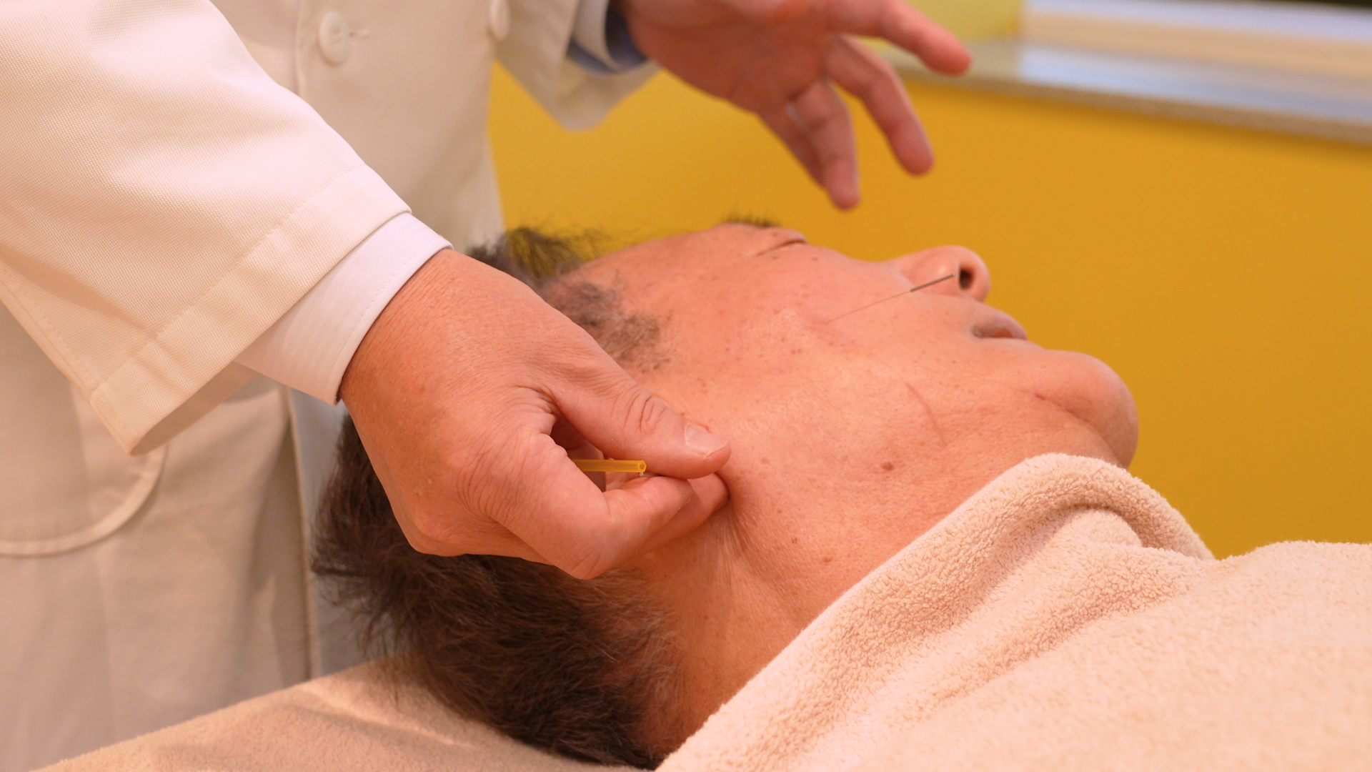 顔面神経麻痺施術特徴2